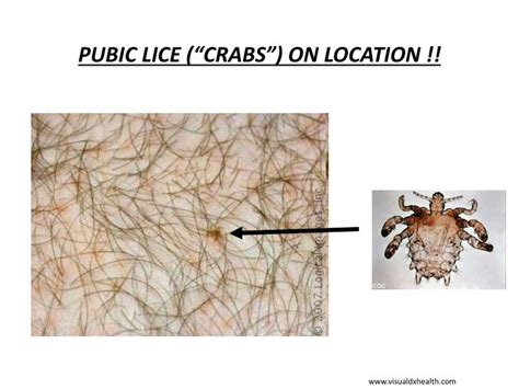 Pic Of Crabs Lice