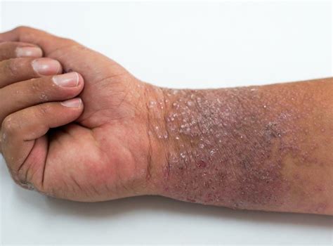Picture Of Eczema