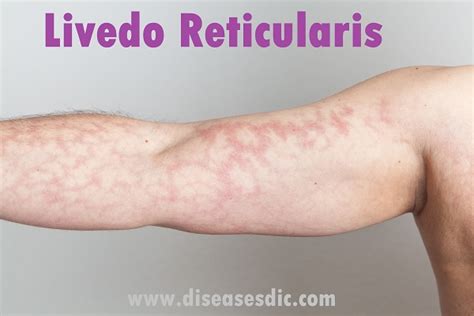 Picture Of Livedo Reticularis Livedo Reticularis Skin Diseases
