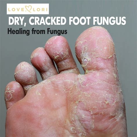Pictures Of Athlete's Foot Fungus