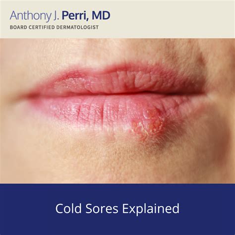 Pictures Of Cold Sores
