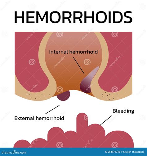 Pictures Of External Hemorrhoids