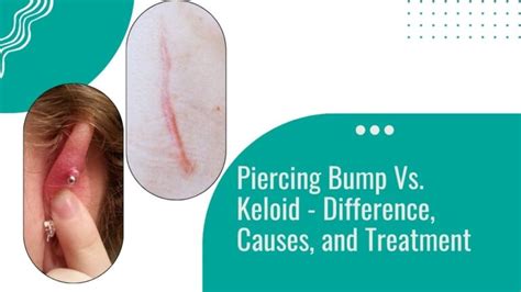 Piercing Bump Vs Keloid - Piercing Aftercare, 50% Off