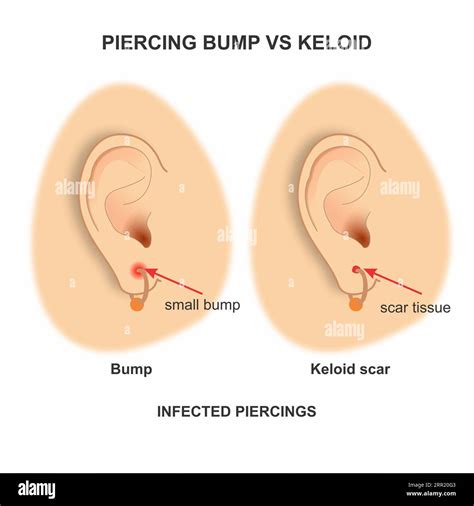 Piercing Bump Vs Keloid
