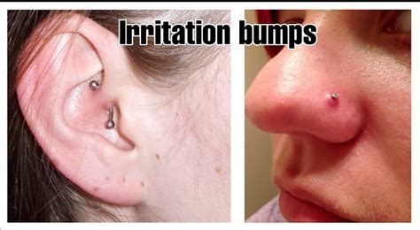 Piercing Bumps Vs Keloids Key Differences And Treatment