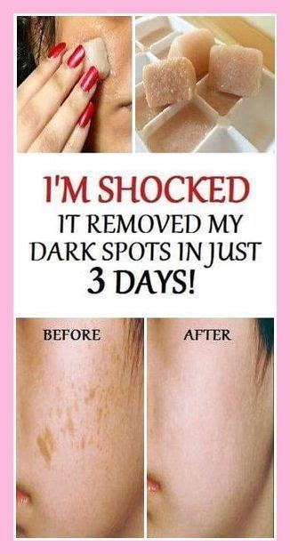 Pin On Natural Skin Lightening Dark Spots