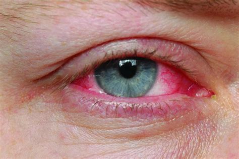 Pink Eye Pictures