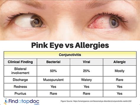 Pink Eye Vs Allergies