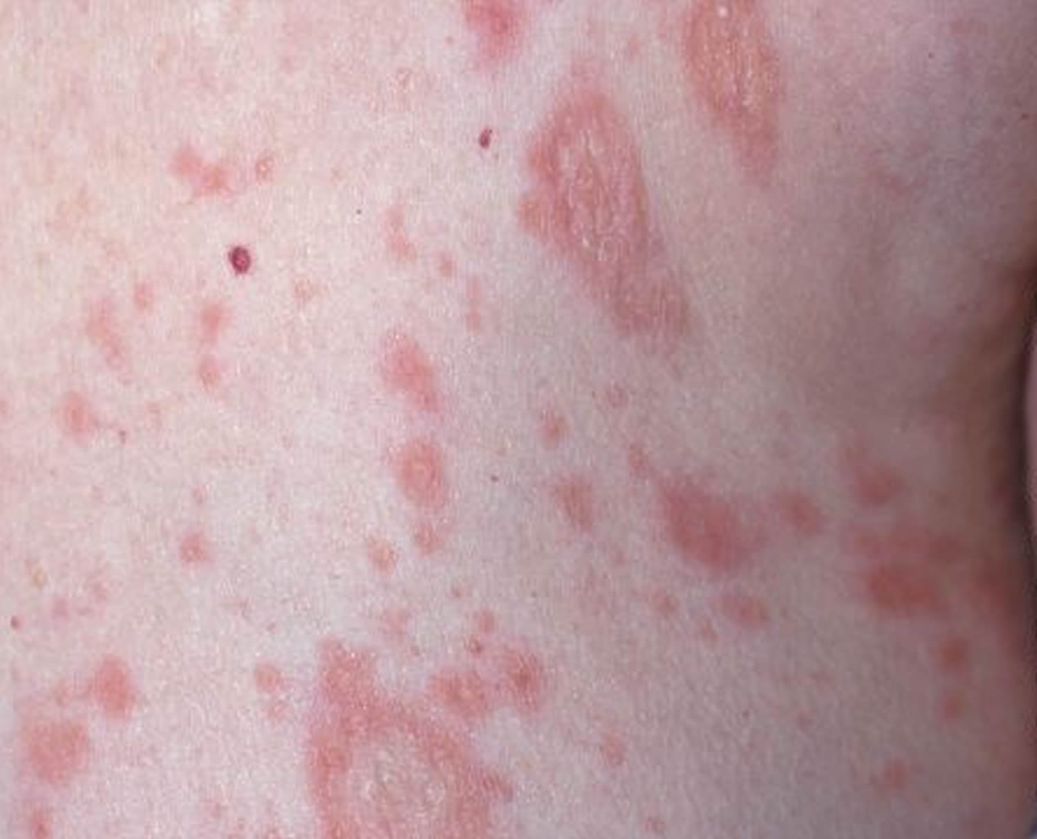 Pityriasis Rosea