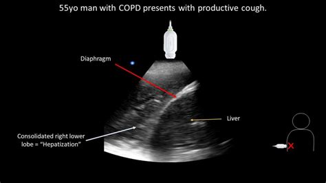 Pneumonia Hepatization Pocus Case Teachim