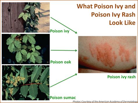 Poison Ivy Rash Poison Oak Poison Sumac Symptoms Causes Treatment