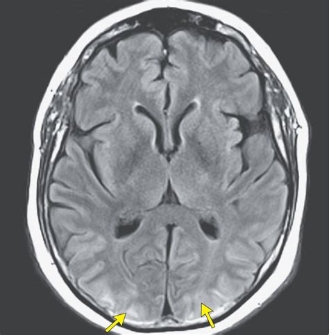 Posterior Reversible Encephalopathy Syndrome Nejm