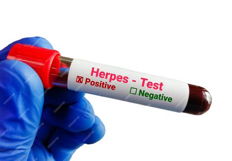 Premium Photo Blood Sample For Herpes Test Herpes Simplex Virus Hsv