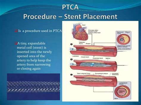 Presentation Ptca