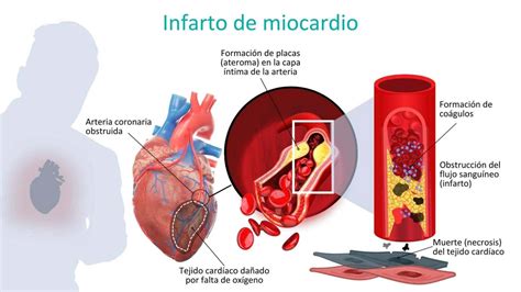 Prevenci N Del Infarto Agudo De Miocardio