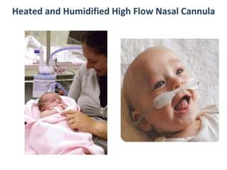Primer On Use Of High Flow Nasal Cannula For Pediatric Bronchiolitis
