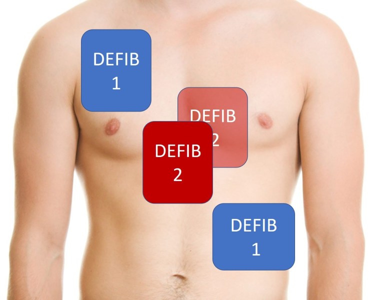 Proper Defibrillator Pad Placement Dual Sequential Defibrillation In