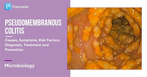 Pseudomembranous Colitis Infectious Diseases Ppt