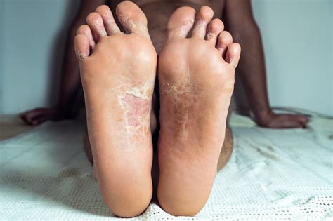 Psoriasis On Feet Images