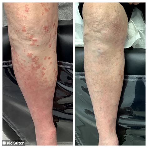Psoriasis On Legs Photos Before After Treatment Pictures Of Patients