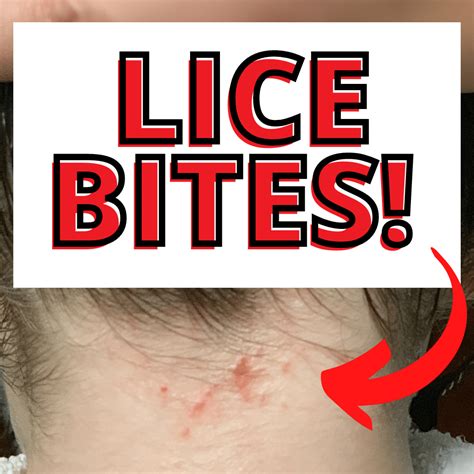Pubic Lice Bites Pictures