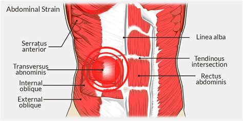 Pulled Abdominal Muscle