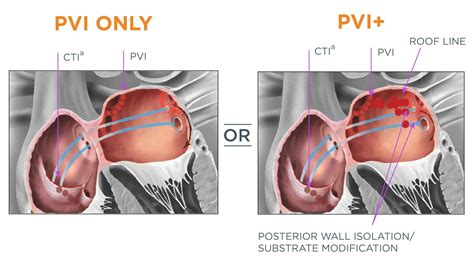 Pvi Medical Abbreviation