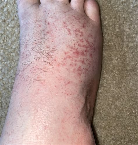 Rash Hives What Is On My Foot R Diagnoseme