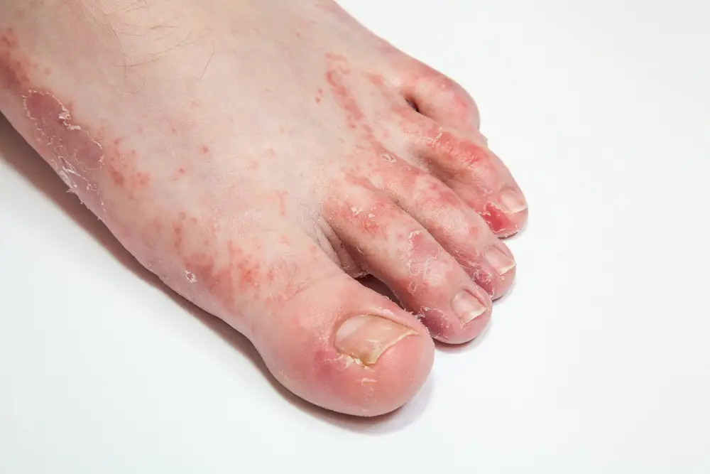 Rash On Foot