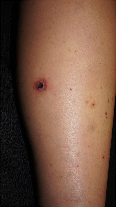 Rash On Lower Legs And Abdomen Mdedge Family Medicine