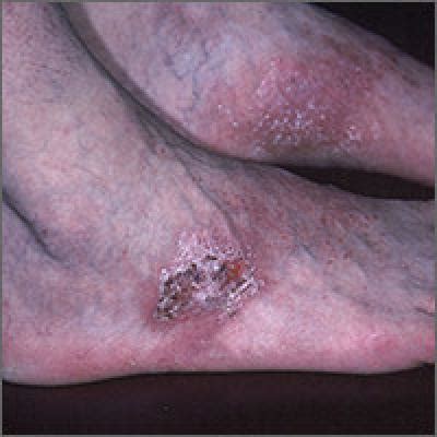 Rash On Top Of Feet Mdedge Family Medicine