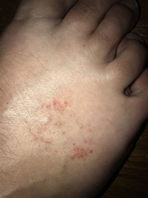 Rash On Top Of Feet