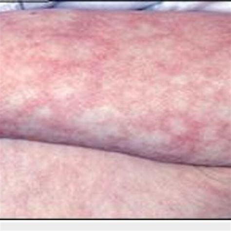Rashes On Patient S Abdomen Download Scientific Diagram