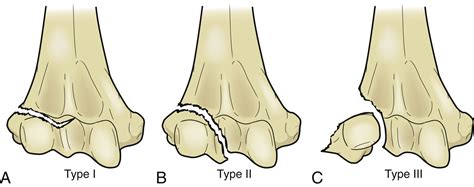Reduction And Fixation Of Lateral Condyle Fractures Of The Distal