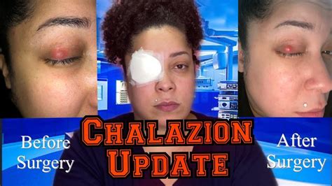 Removal Of Chalazion