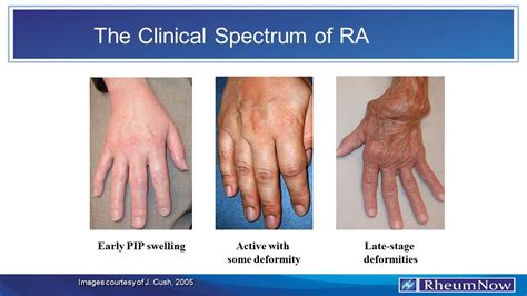 Rheumatoid Arthritis Clinical Gate