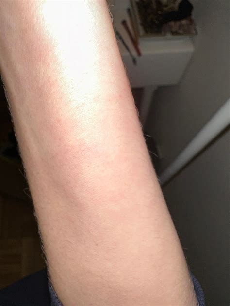 Ringworm Pityriasis Rosea Or Something Else R Dermatologyquestions