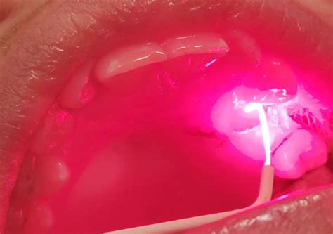 Safe And Effective Photodynamic Therapy Dentistry Co Uk