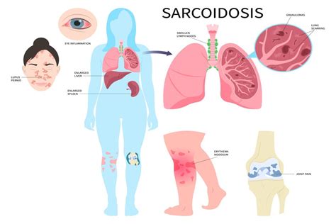 Sarcoidosis