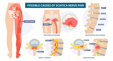 Sciatic Nerve Pain Relief Fredericksburg Spotsylvania Chiropractor