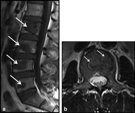 Sclerotic Lesions Of The Spine Mri Assessment Mugera 2013