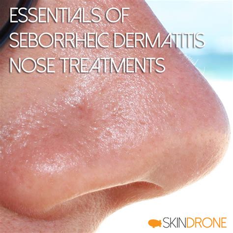 Seborrhoeic Dermatitis On The Nose Stock Image C014 2672 Science