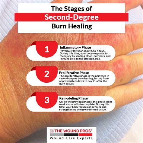 Second Degree Burn Healing Process Pictures