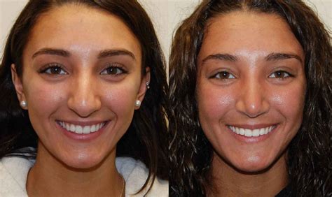 Septoplasty Before And After Pictures Haha Wallpaper Vrogue Co