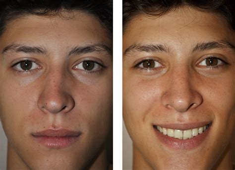Septoplasty Before And After
