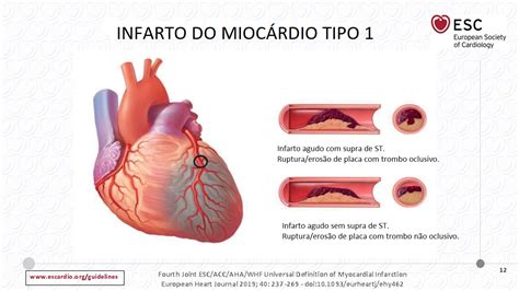 Sintomas Do Infarto Agudo Do Mioc Rdio