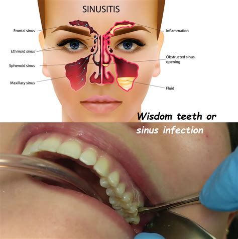 Sinus Infection Causes Dental Pain