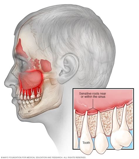 5 Ways To Ease Sinus Tooth Pain