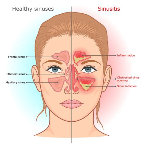 Sinus Pain Without Congestion