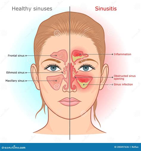 Sinusitis Infection Vector Illustration Stock Vector Illustration Of